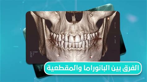 DentaScan : Panorama Vs CBCT .. الفرق بين أشعة البانوراما و الأشعة .